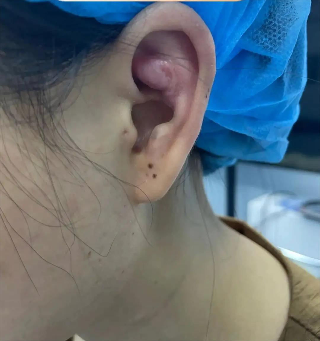 耳甲艇软骨增生图片